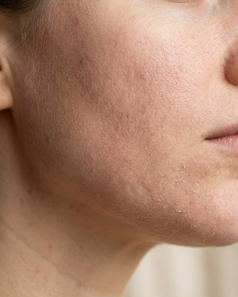 Dull Skin or Pigmentation